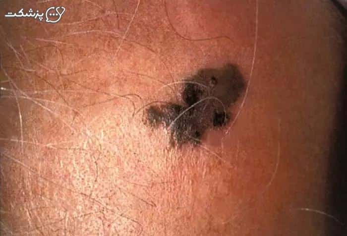 خارش خال سیاه-پزشکت